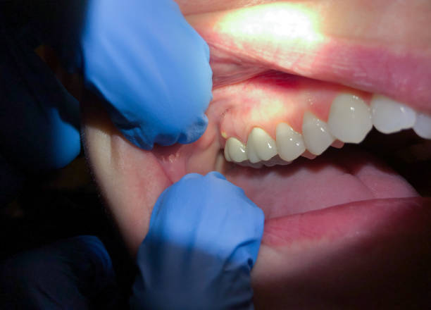 Best Emergency Care for Gum Disease in Pecan Acres, TX